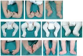 El método Ponseti consiste en enyesar durante varias semanas el niño, mientras se realiza una corrección de la postura del pie, para finalmente tener una posición natural y adecuada