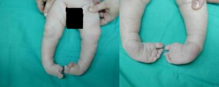 El pie zambo se puede diagnosticar justo después del parto, o incluso antes del mismo, a través de la ecografía