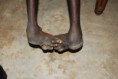 /album/fotogaleria/clubfoot4-jpg/